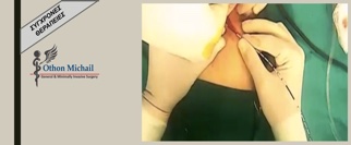 Θεραπεία Περιεδρικού Συριγγίου