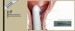 Αναίμακτη Θεραπεία Αιμορροϊδων